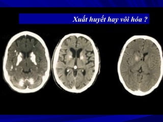 Xuất huyết hay vôi hóa ?
 