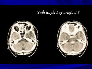 Xuất huyết hay artefact ?
 