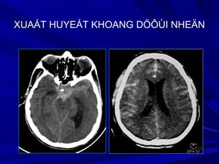 EDH
XUAÁT HUYEÁT KHOANG DÖÔÙI NHEÄN
 