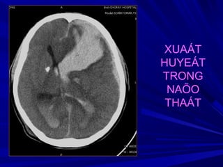 XUAÁT
HUYEÁT
TRONG
NAÕO
THAÁT
 