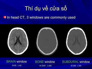Thí dụ về cửa sổThí dụ về cửa sổ
BRAINBRAIN windowwindow
W:80 L:40W:80 L:40
BONEBONE windowwindow
W:2500 L:480W:2500 L:480
SUBDURALSUBDURAL windowwindow
W:350 L:90W:350 L:90
In head CT, 3 windows are commonly usedIn head CT, 3 windows are commonly used
 
