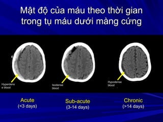 Mật độ của máu theo thời gianMật độ của máu theo thời gian
trong tụ máu dưới màng cứngtrong tụ máu dưới màng cứng
AcuteAcute
(<3 days)(<3 days)
Sub-acuteSub-acute
(3-14 days)(3-14 days)
ChronicChronic
(>14 days)(>14 days)
Hyperdens
e blood
Isodense
blood
Hypodense
blood
 