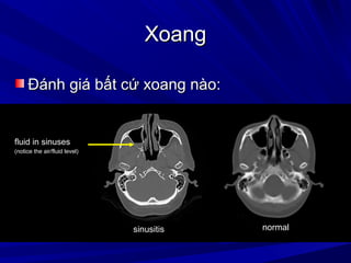 XoangXoang
Đánh giá bất cứ xoang nào:Đánh giá bất cứ xoang nào:
fluid in sinusesfluid in sinuses
(notice the air/fluid level)(notice the air/fluid level)
normalsinusitis
 