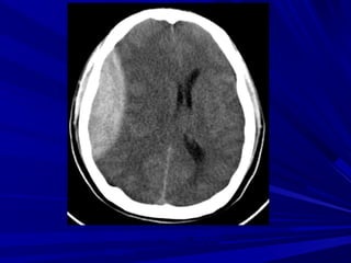 Thoaùt vò naõo döôùi
lieàm
 