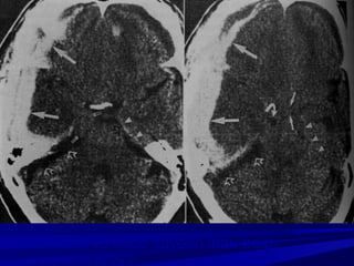 Thoaùt vò naõo xuyeân leàu treân
 