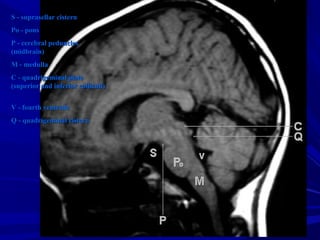 S - suprasellar cisternS - suprasellar cistern
Po - ponsPo - pons
P - cerebral pedunclesP - cerebral peduncles
(midbrain)(midbrain)
M - medullaM - medulla
C - quadrigeminal plateC - quadrigeminal plate
(superior and inferior colliculi)(superior and inferior colliculi)
V - fourth ventricleV - fourth ventricle
Q - quadrigeminal cisternQ - quadrigeminal cistern
 
