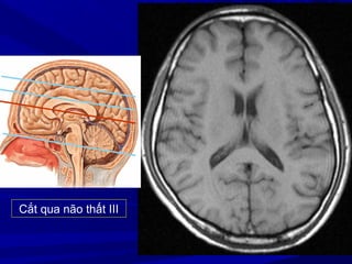 Cắt qua não thất III
 