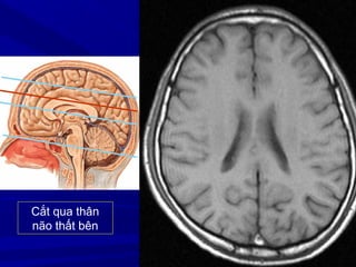 Cắt qua thân
não thất bên
 