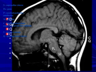 NỘI DUNG TRÌNH BÀYNỘI DUNG TRÌNH BÀY
Đại cương về CT Scan sọ nãoĐại cương về CT Scan sọ não
Giải phẫu học cơ bảnGiải phẫu học cơ bản
Quy trình chung đọc CT Scan sọ nãoQuy trình chung đọc CT Scan sọ não
CT Scan trong một số bệnh lý:CT Scan trong một số bệnh lý:
* Đột quỵ (tai biến mạch máu não)* Đột quỵ (tai biến mạch máu não)
* U não* U não
* Viêm-Nhiễm* Viêm-Nhiễm
* Chấn thương* Chấn thương
* Một số bệnh lý khác.* Một số bệnh lý khác.
S - suprasellar cisternS - suprasellar cistern
Po - ponsPo - pons
P - cerebral pedunclesP - cerebral peduncles
(midbrain)(midbrain)
M - medullaM - medulla
C - quadrigeminal plateC - quadrigeminal plate
(superior and inferior colliculi)(superior and inferior colliculi)
V - fourth ventricleV - fourth ventricle
Q - quadrigeminal cisternQ - quadrigeminal cistern
 