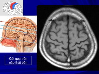 Cắt qua trên
não thất bên
 