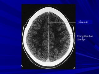 Liềm não
Trung tâm bán
bầu dục
 