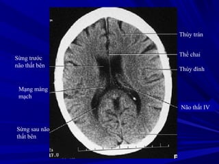 Thùy trán
Thể chai
Thùy đính
Não thất IV
Sừng trước
não thất bên
Sừng sau não
thất bên
Mạng màng
mạch
 