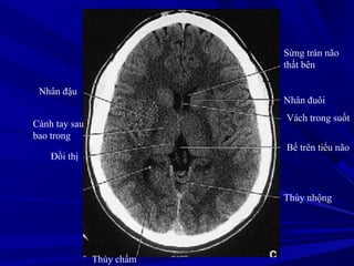 Nhân đậu
Cánh tay sau
bao trong
Đồi thị
Sừng trán não
thất bên
Nhân đuôi
Vách trong suốt
Bể trên tiểu não
Thùy nhộng
Thùy chẩm
 