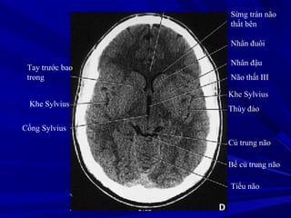 Sừng trán não
thất bên
Nhân đuôi
Nhân đậu
Não thất III
Khe Sylvius
Thùy đảo
Củ trung não
Bể củ trung não
Tiểu não
Tay trước bao
trong
Khe Sylvius
Cống Sylvius
 