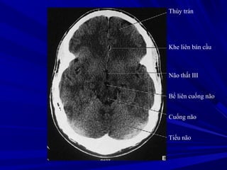 Thùy trán
Khe liên bán cầu
Não thất III
Bể liên cuống não
Cuống não
Tiểu não
 