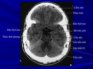 Liềm não
Thùy trán
Khe Sylvius
Bể trên yên
Cầu não
Lều tiểu não
Não thất IV
Tiểu não
Khe Sylvius
Thùy thái dương
 