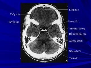 Liềm não
Lưng yên
Thùy thái dương
Bể trước cầu não
Xương chủm
Não thất IV
Tiểu não
Thùy trán
Tuyến yên
 