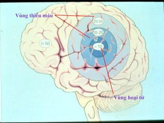 Vùng hoại tử
Vùng thiếu máu
 