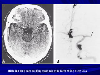 Hình ảnh tăng đậm độ động mạch não giữa kiểm chứng bằng DSA
 