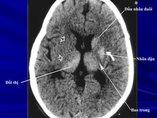 Nhân đậu
Bao trong
Đầu nhân đuôi
Đồi thị
 