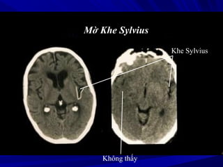 Mờ Khe Sylvius
Khe Sylvius
Không thấy
 