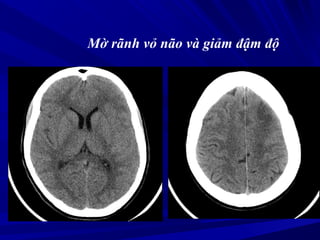 Mờ rãnh vỏ não và giảm đậm độ
 