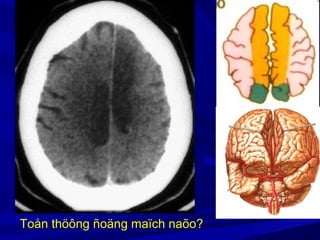 Toån thöông ñoäng maïch naõo?
 