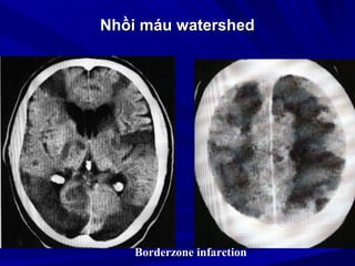 Nhồi máu watershedNhồi máu watershed
Borderzone infarction
 
