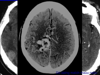 Dò daïng maïch maùu naõo
 