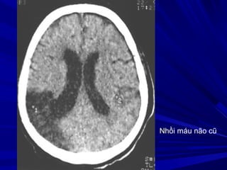 Nhồi máu não cũ
 