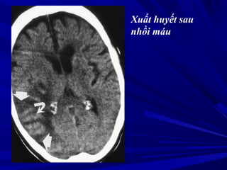 Xuất huyết sau
nhồi máu
 