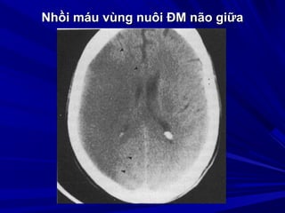 Nhồi máu vùng nuôi ĐM não giữaNhồi máu vùng nuôi ĐM não giữa
 