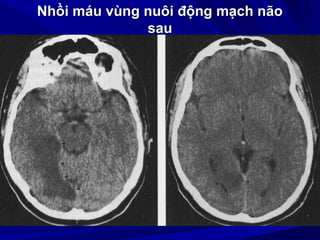 Nhồi máu vùng nuôi động mạch nãoNhồi máu vùng nuôi động mạch não
sausau
 
