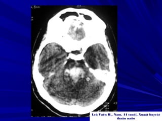 Leâ Vaên H., Nam, 44 tuoåi, Xuaát huyeát
thaân naõo
 