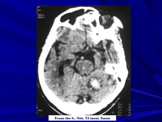 Traàn thò S., Nöõ, 73 tuoåi, Xuaát
 