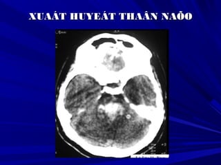 XUAÁT HUYEÁT THAÂN NAÕOXUAÁT HUYEÁT THAÂN NAÕO
 