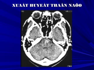 XUAÁT HUYEÁT THAÂN NAÕOXUAÁT HUYEÁT THAÂN NAÕO
 