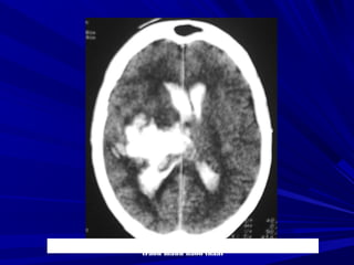 Buøi vaên L., Nam, 45 tuoåi, Xuaát huyeát nhaân beøo-bao trong (P) coù
traøn maùu naõo thaát
 