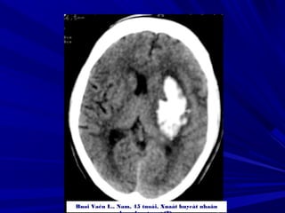 Buøi Vaên L., Nam, 45 tuoåi, Xuaát huyeát nhaân
 