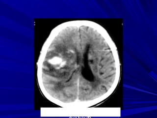 Nguyeãn Vaên L., Nam, 67 tuoåi, Xuaát huyeát
thaùi döông (P)/ Nhuõn naõo cuõ caïnh naõo
 