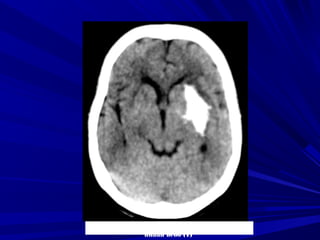 Nguyeãn Thò Q., Nöõ, 49 tuoåi, Xuaát huyeát
nhaân beøo (T)
 