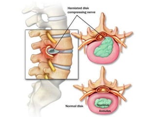Herniated Nucleus Pulposus | PPT