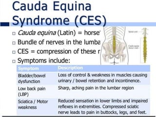 Weakness in both legs and the loss of
bladder and/or bowel control are symptoms of
a specific and severe type of nerve root
compression called CAUDA EQUINA
SYNDROME.
 