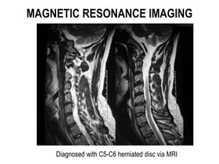 MAGNETIC RESONANCE IMAGING
Diagnosed with C5-C6 herniated disc via MRI
 
