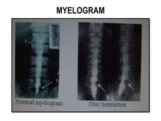 MYELOGRAM
 