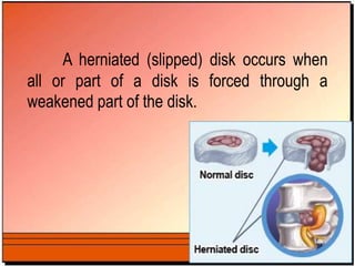 A herniated (slipped) disk occurs when
all or part of a disk is forced through a
weakened part of the disk.
 