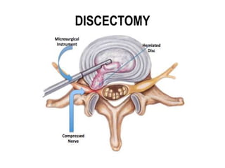DISCECTOMY
 