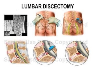 LUMBAR DISCECTOMY
 