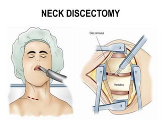 NECK DISCECTOMY
 