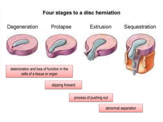 deterioration and loss of function in the
cells of a tissue or organ
slipping forward
process of pushing out
abnormal separation
 